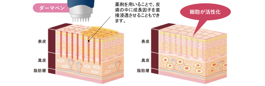 ダーマペン④の仕組み