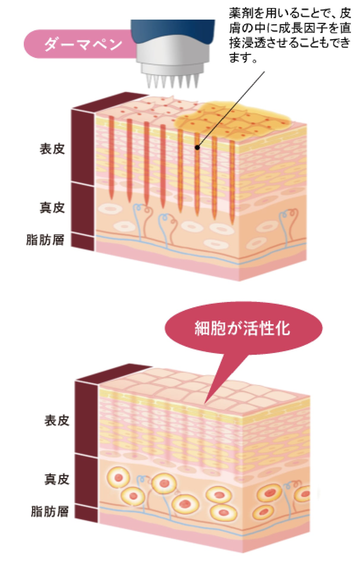 ダーマペン④の仕組み