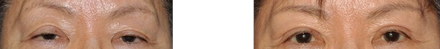 Upper and lower eyelid lifts