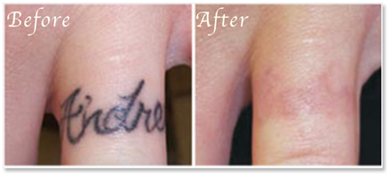 Tattoo removal