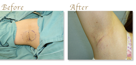 Hyperhidrosis surgery