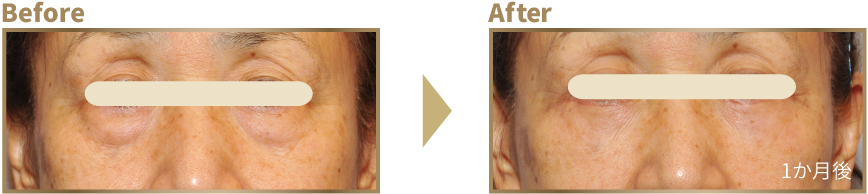 下まぶたのたるみ取り ビフォーアフター