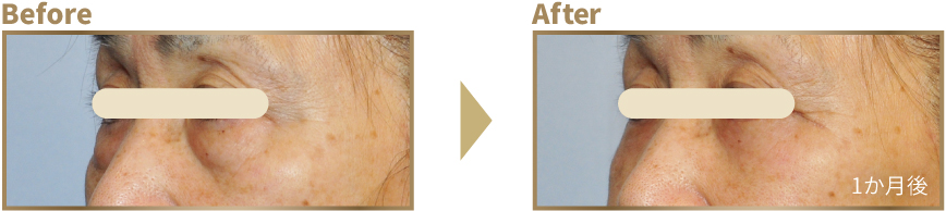 下まぶたのたるみ取り ビフォーアフター