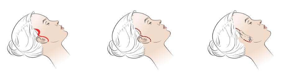 手術の流れを説明したイラスト