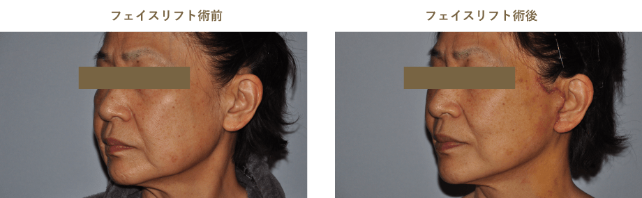 フェイスリフト術前術後のイメージ