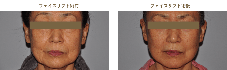 フェイスリフト術前術後のイメージ