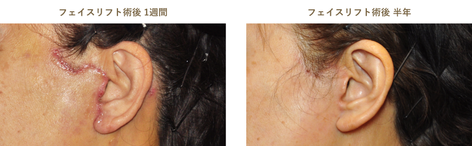 フェイスリフト術前術後のイメージ