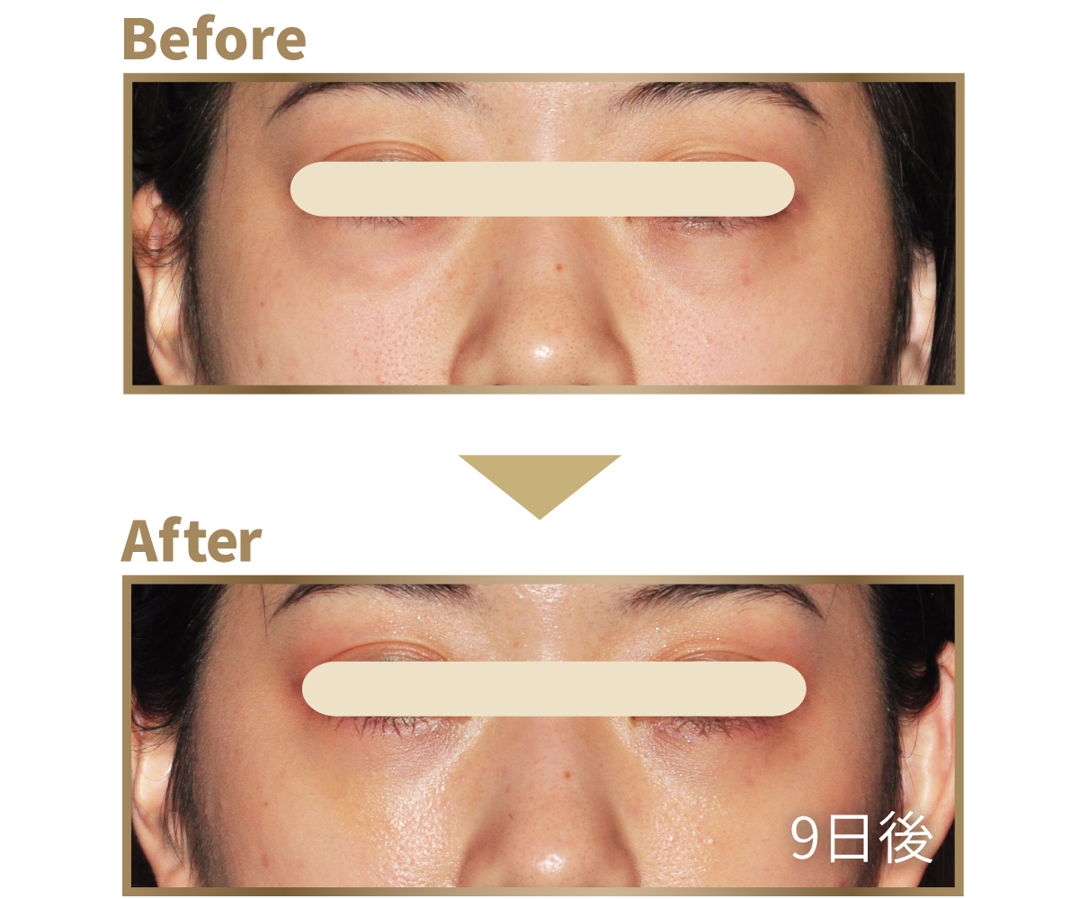 下まぶたのたるみ取り ビフォーアフター