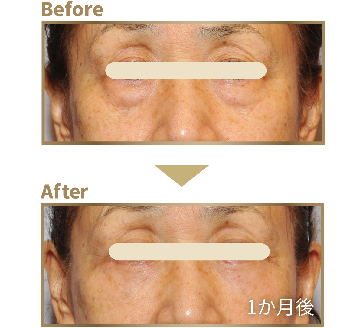 下まぶたのたるみ取り ビフォーアフター