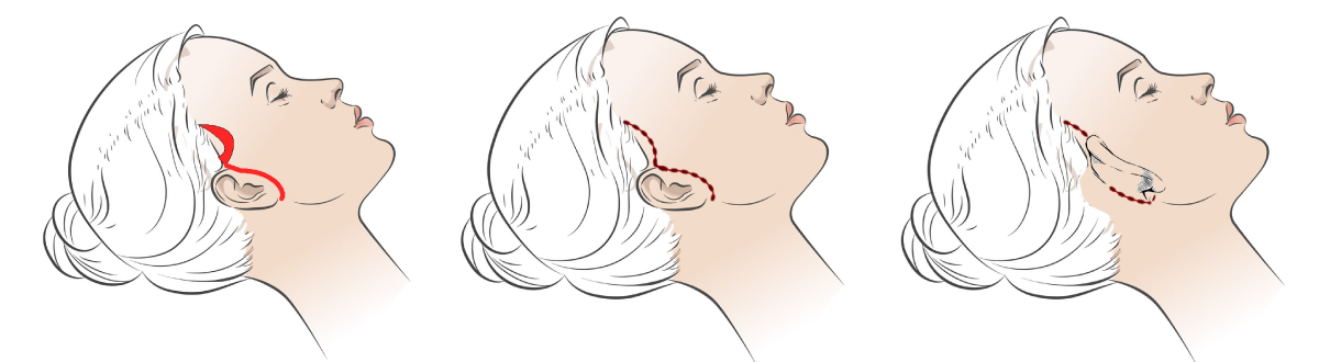 手術の流れを説明したイラスト