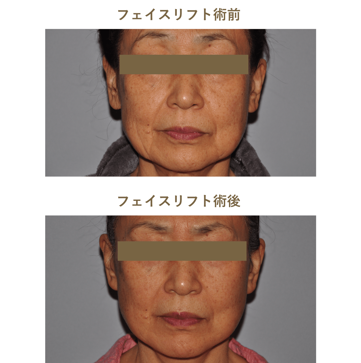 フェイスリフト術前術後のイメージ