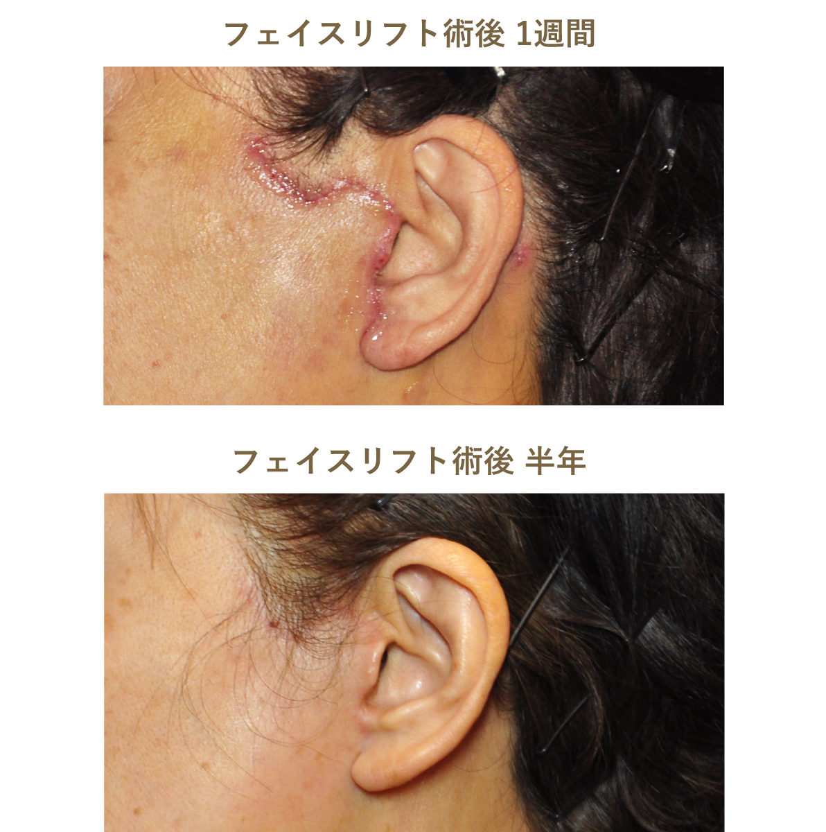 フェイスリフト術前術後のイメージ