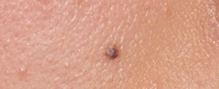 単純黒子（ほくろ）