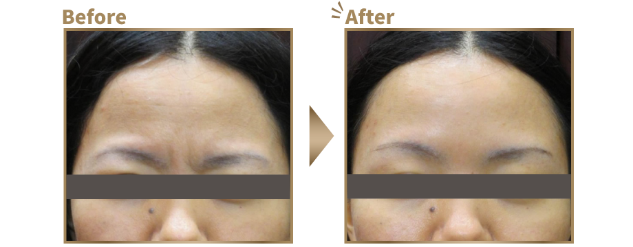眉間しわ寄せ ビフォーアフター