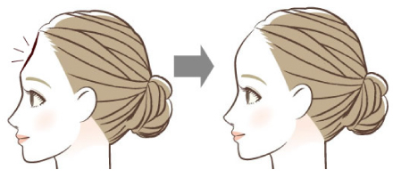 おでこを丸くしたい