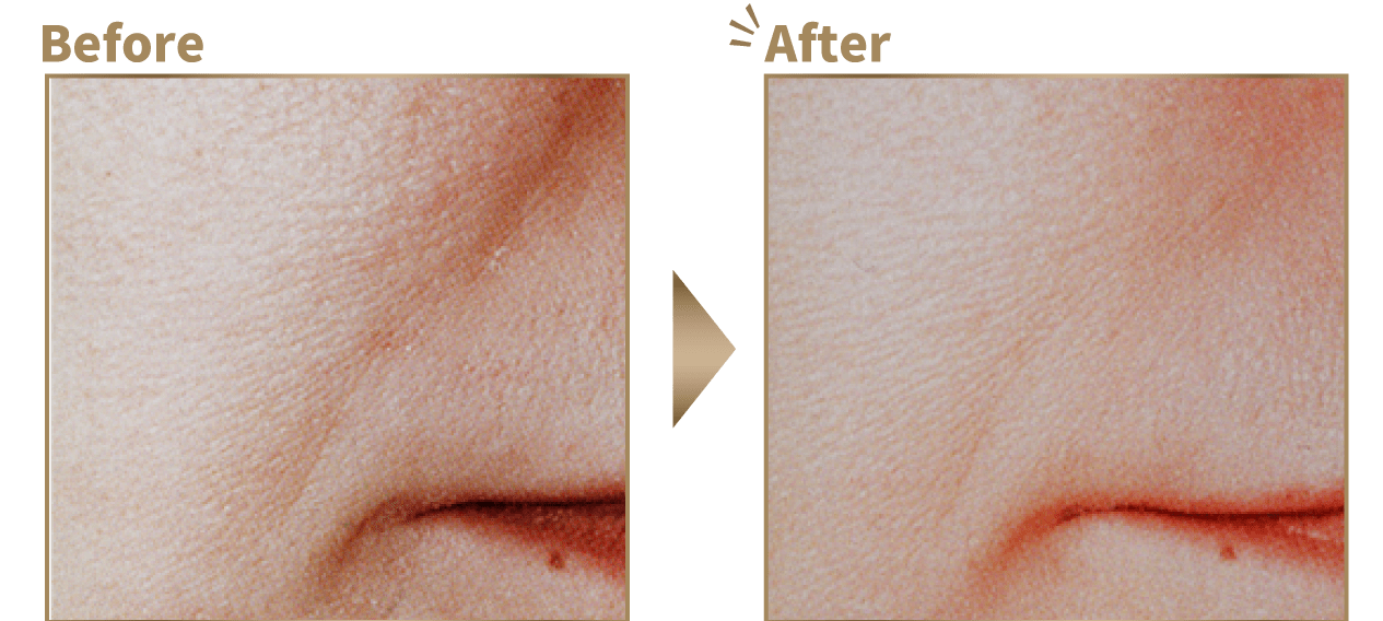 ヒアルロン酸をほうれい線と頬に注入したビフォーアフターイメージ