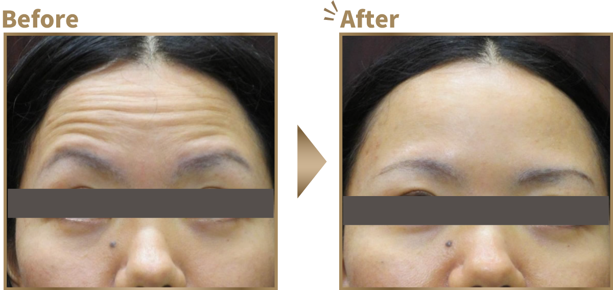 おでこのしわ寄せ ビフォーアフター