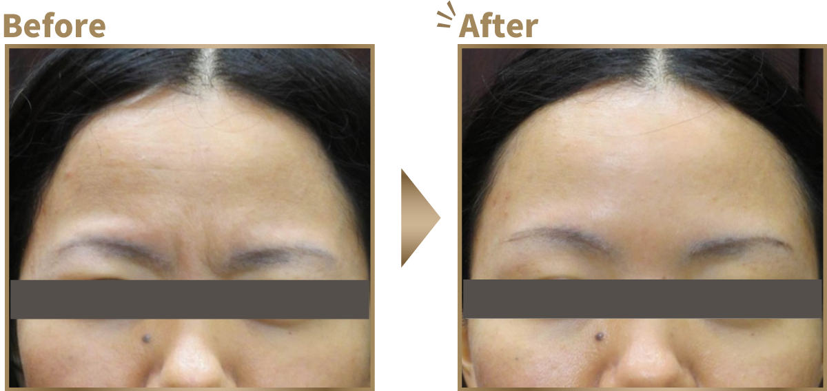 眉間しわ寄せ ビフォーアフター