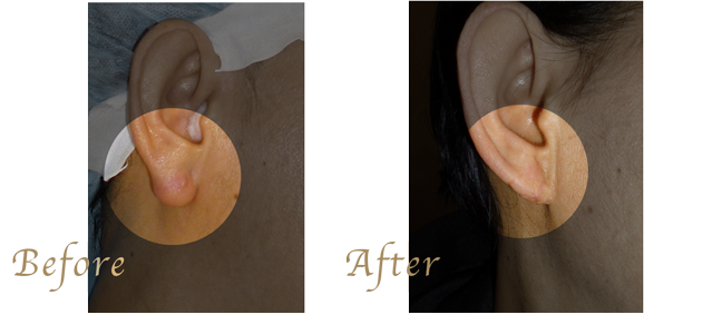 耳たぶのケロイド治療