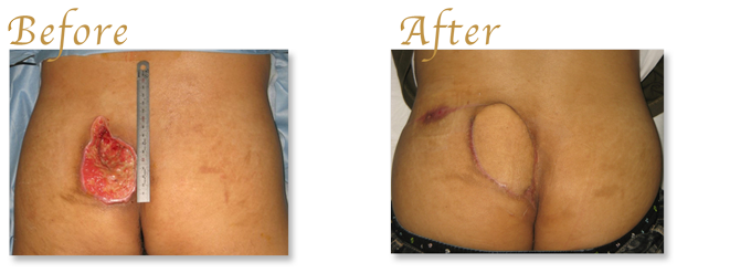 床ずれ・潰瘍の治療