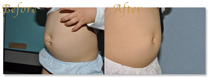 へそ形成/出べそ