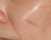 頬についた傷跡