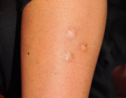 根性焼きの傷跡