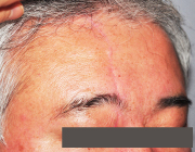 交通事故の傷跡