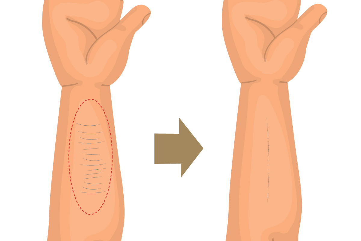 切除法イラスト