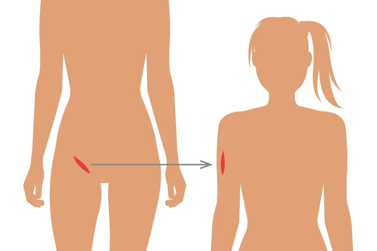 皮膚移植法(植皮術)
