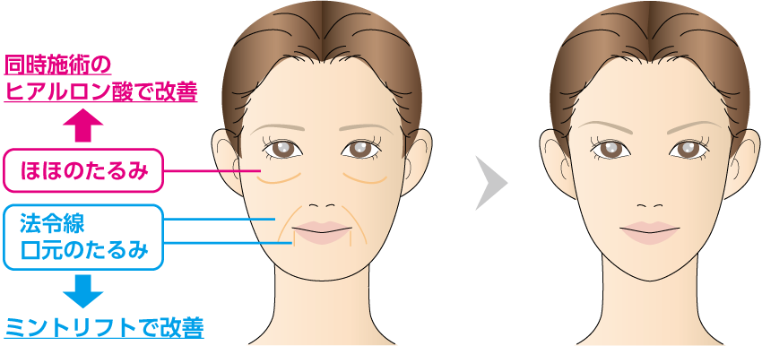 ほほのたるみ・・同時施術のヒアルロン酸で改善　法令線口元のたるみ・・・ミントリフトで改善